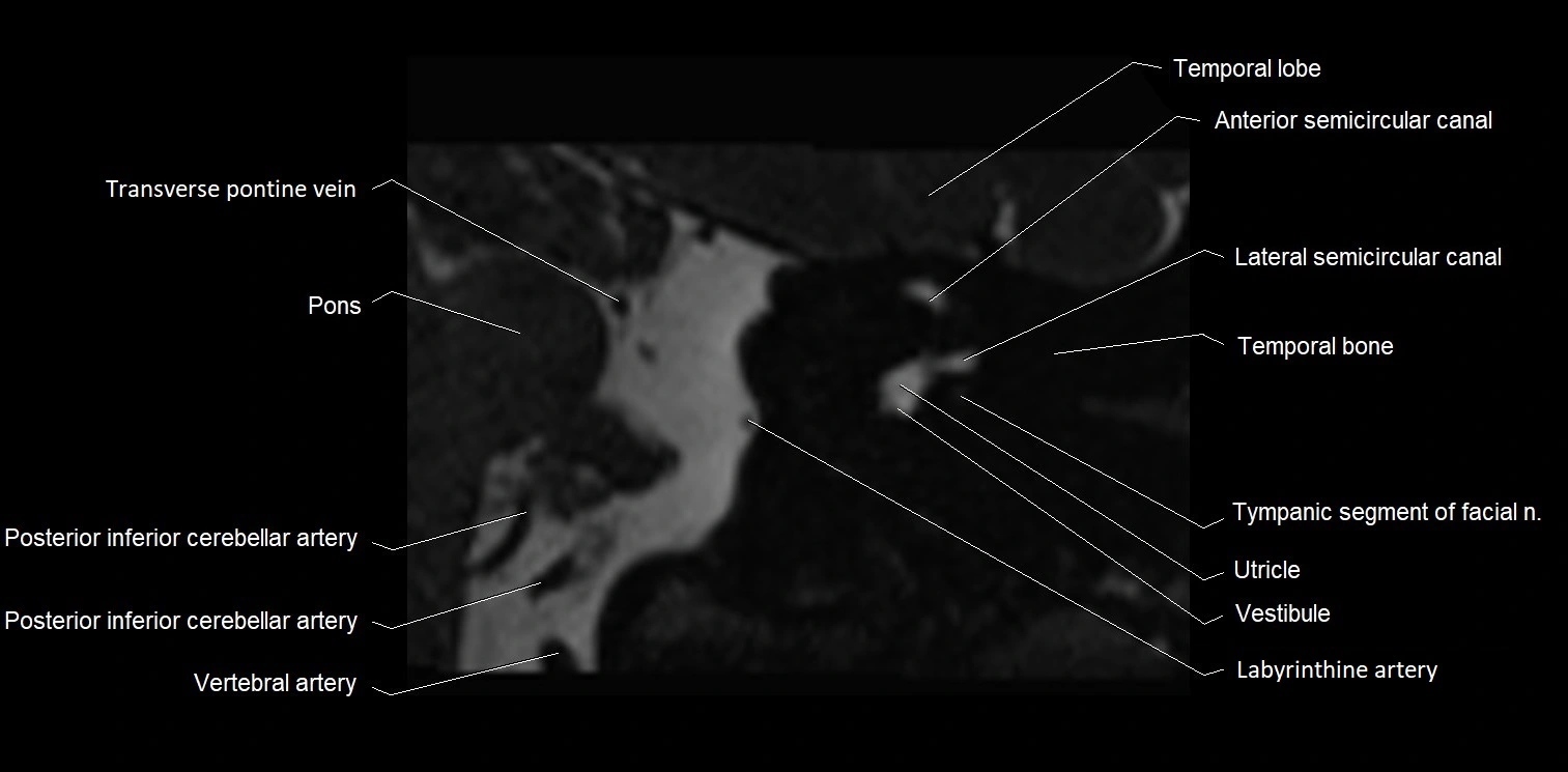 Internal auditory meatus (IAM) axial cross sectional anatomy image 20.webp